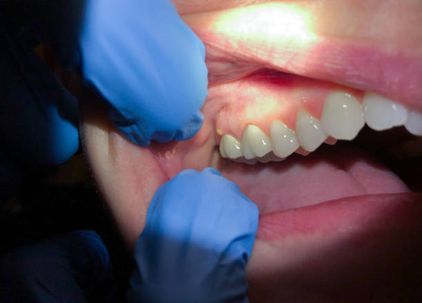 Best Emergency Wisdom Teeth Removal in Monona, WI