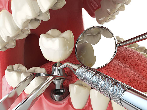 Best Urgent Care for Lost Fillings or Crowns in Monona, WI